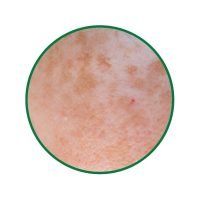 Close-up of pigmented skin texture – Dark Spots & Pigmentation treatment category